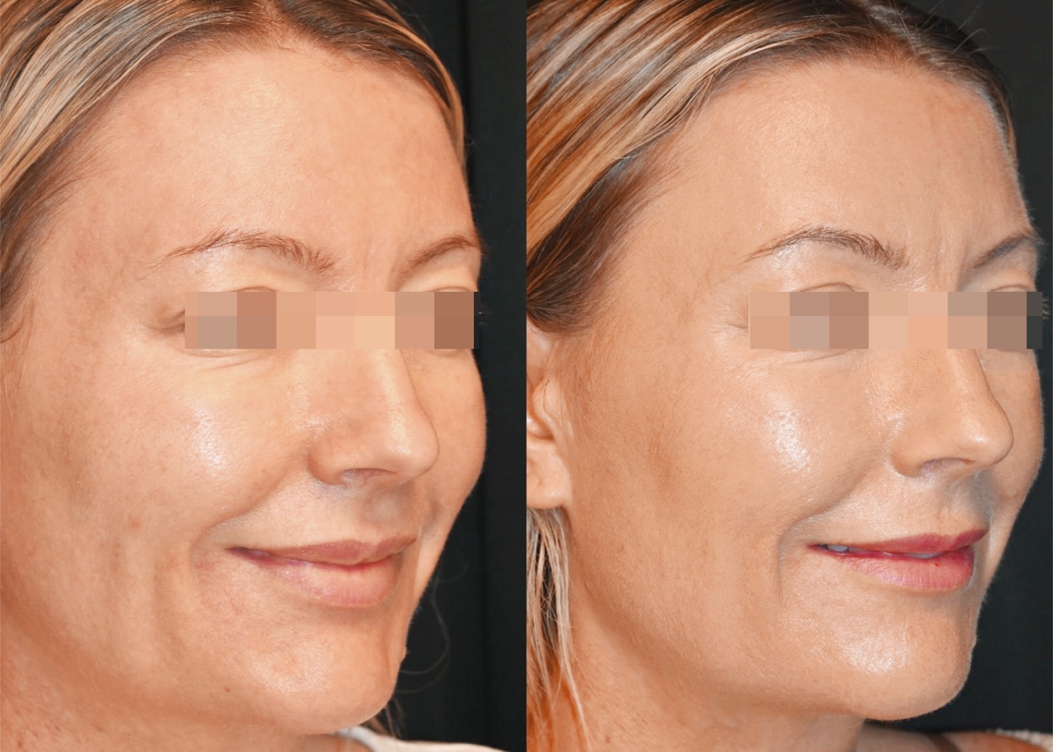 Juläine before and after results showing nasolabial fold reduction at 2 months post-treatment